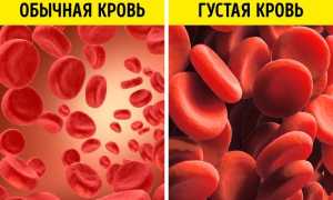 Густая кровь у новорожденного — причины и последствия для здоровья