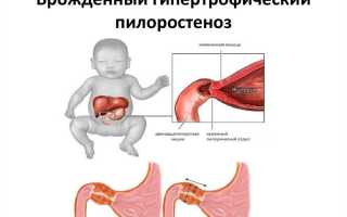 Пилоростеноз у новорожденных — причины, симптоматика, диагностика и лечение