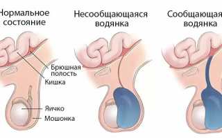 Водянка яичек у новорожденных мальчиков — что это, симптомы и лечение, важные рекомендации
