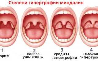 Что делать, если увеличены миндалины у ребенка младше года: советы и рекомендации