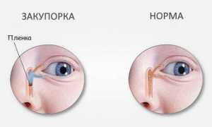 Непроходимость слезного канала у новорожденных — симптомы закупорки и методы лечения