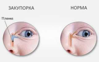 Непроходимость слезного канала у новорожденных — симптомы закупорки и методы лечения