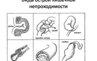 Непроходимость кишечника у ребенка — симптомы и лечение