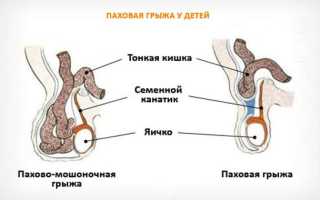 Болит в паху у ребенка — причины, описание симптомов и рекомендации