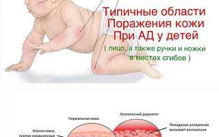 Покраснения у ребенка на локтях, сгибах рук — что это такое и как с этим справиться