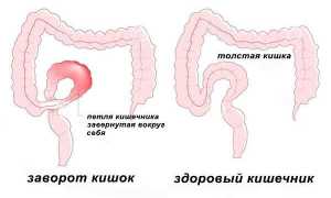 У ребенка болит живот в области пупка — возможные причины и рекомендации