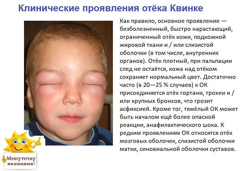 Отёк Квинке на веках