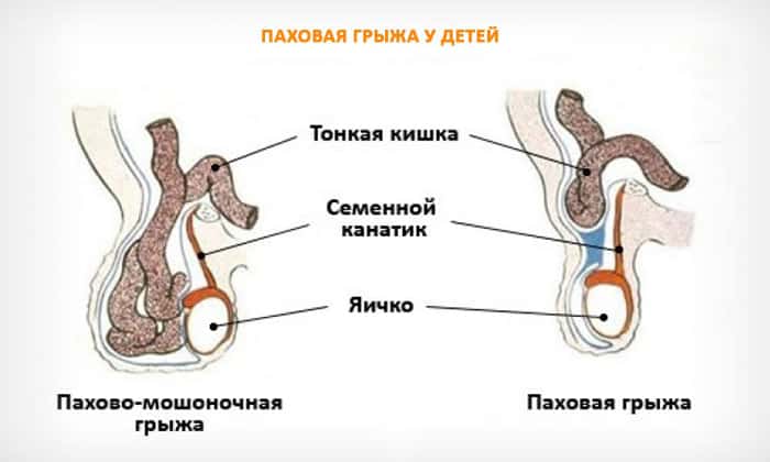Паховая грыжа у детей
