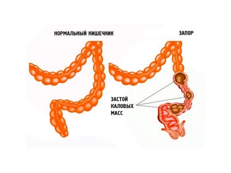 Затруднение проходимости кишечника