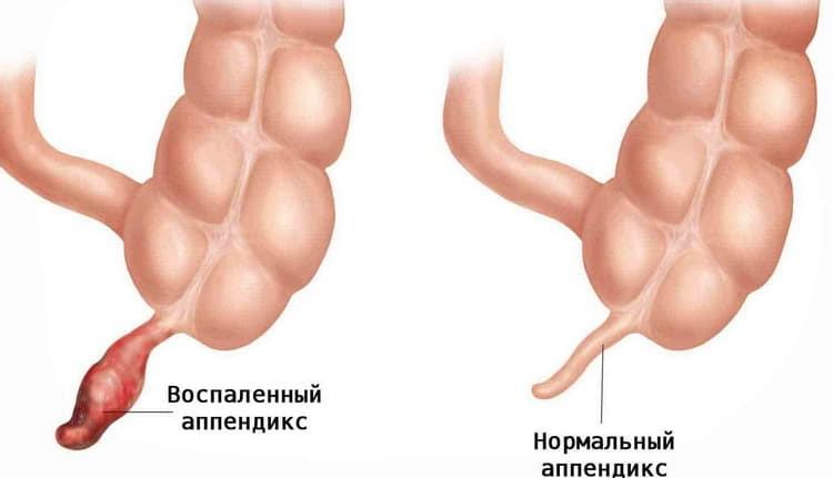 Острый аппендицит