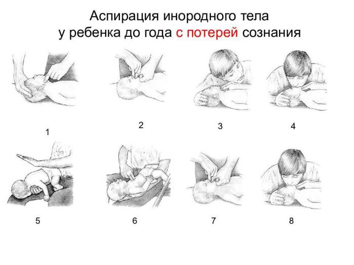Аспирация инородного тела