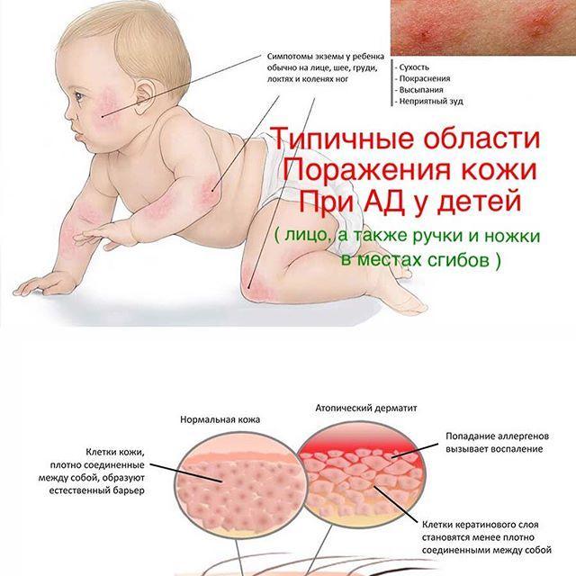 Признаки атопического дерматита