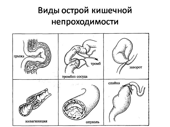 Виды илеуса