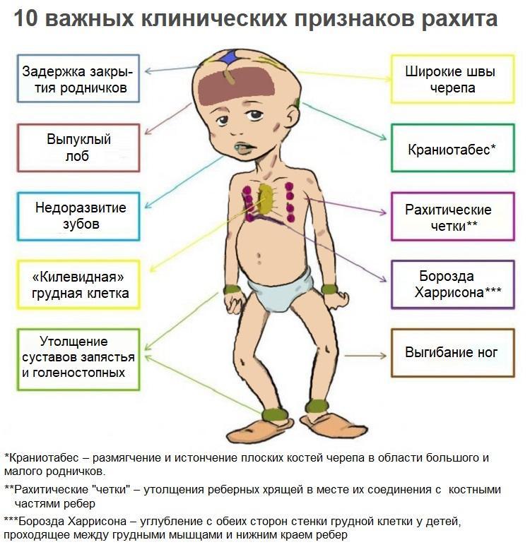 Признаки рахита