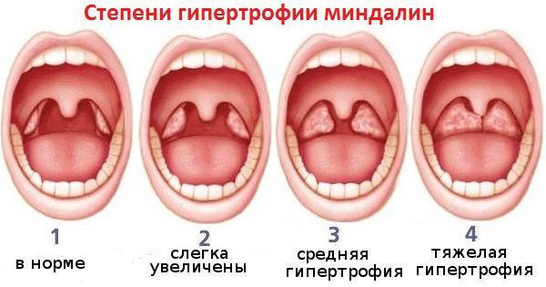 Стадии увеличения миндалин