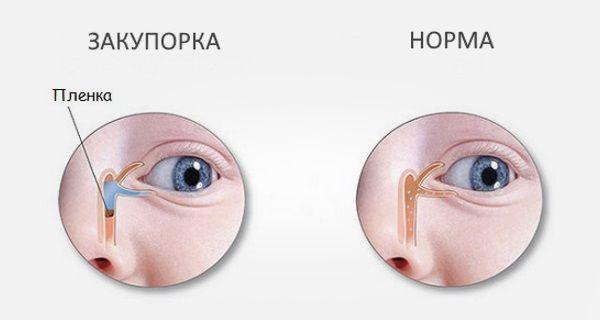 Так выглядит стеноз глаза