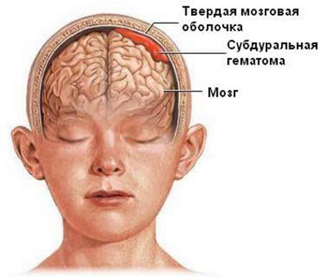 Травма с гематомой