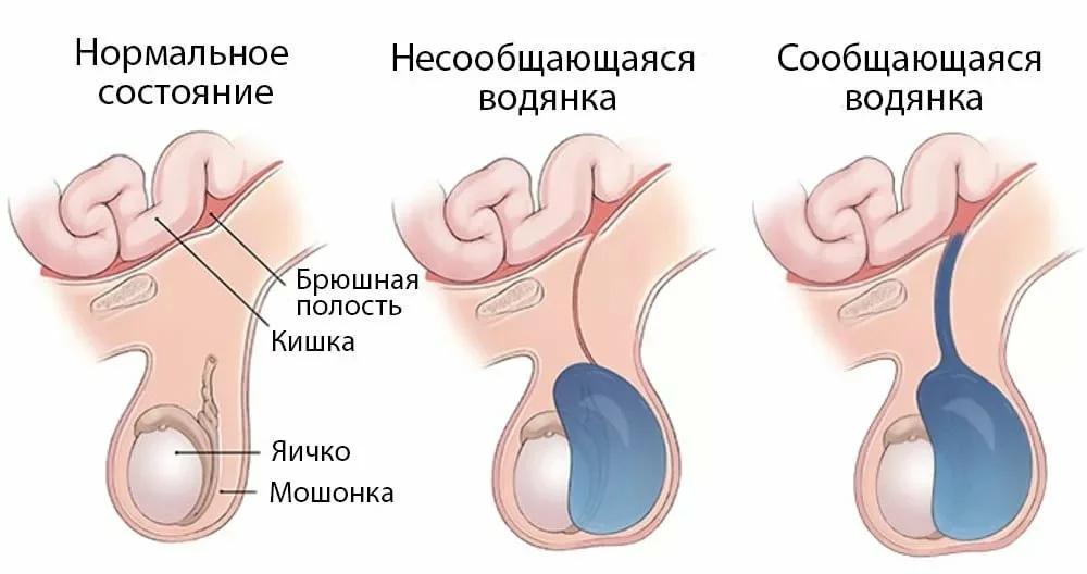 Сообщающаяся и несообщающаяся водянка яичка
