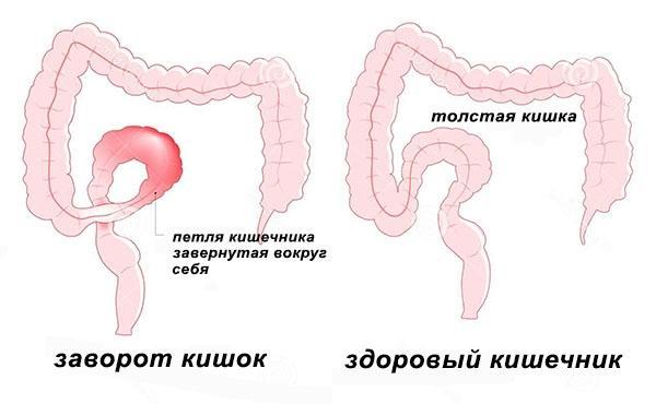 Заворот кишок