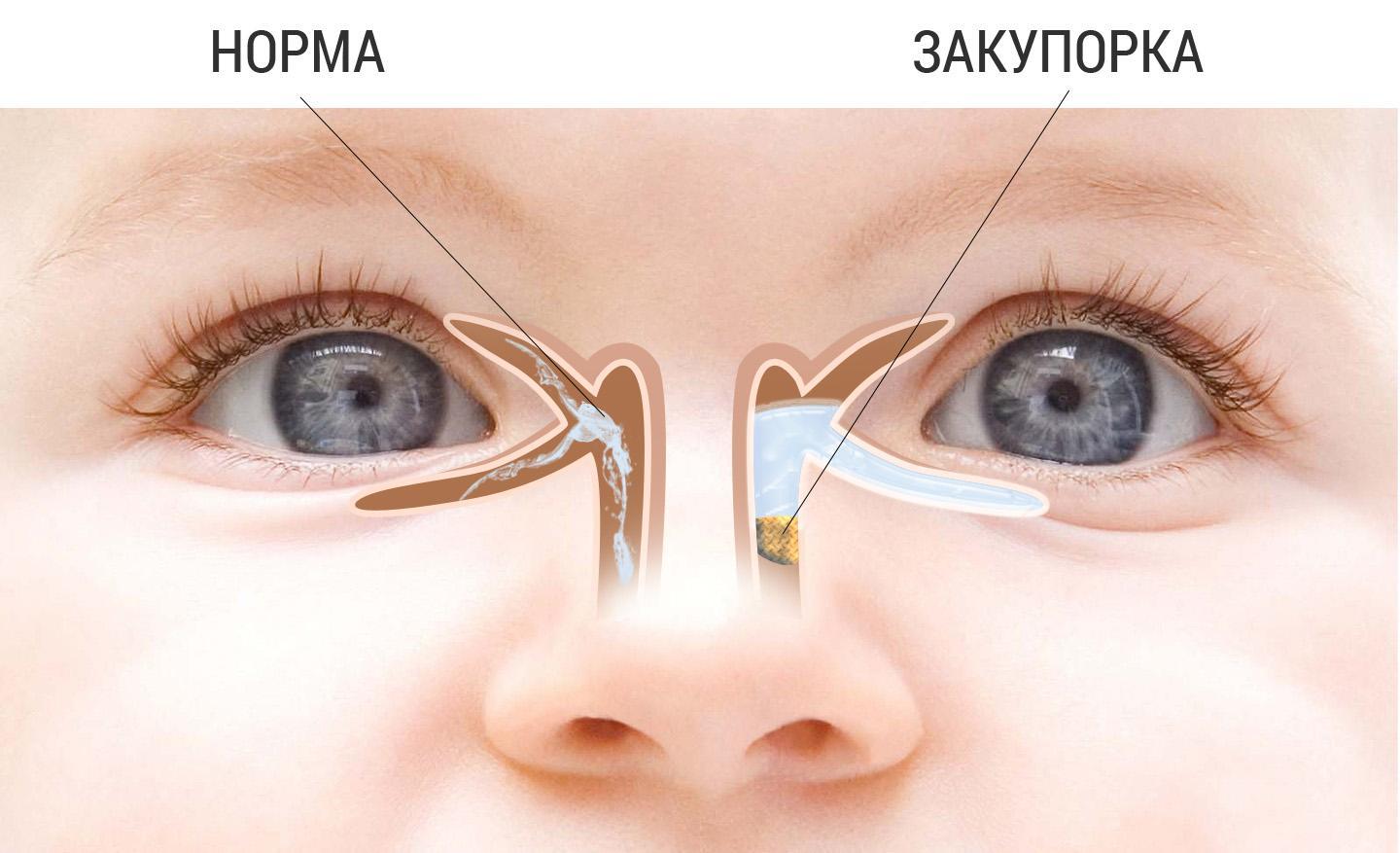 Норма и закупорка в слезном канале