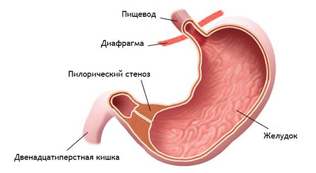 Пилорический стеноз