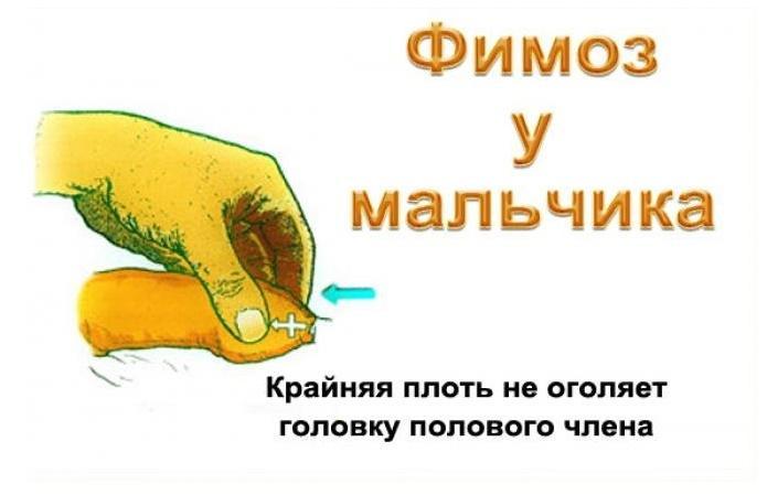 Фимоз у мальчика