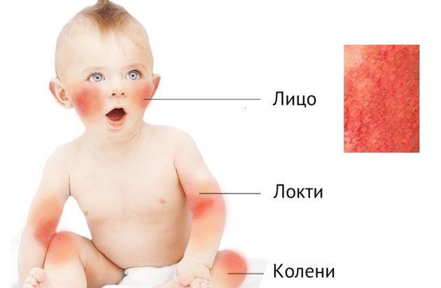 Пищевая аллергия у ребенка