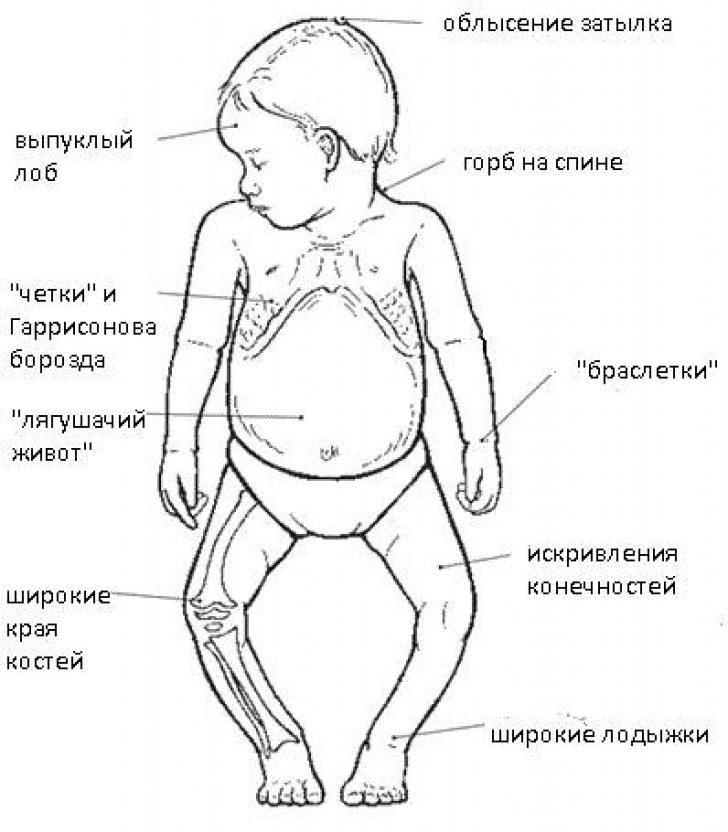 Симптомы рахита у ребенка