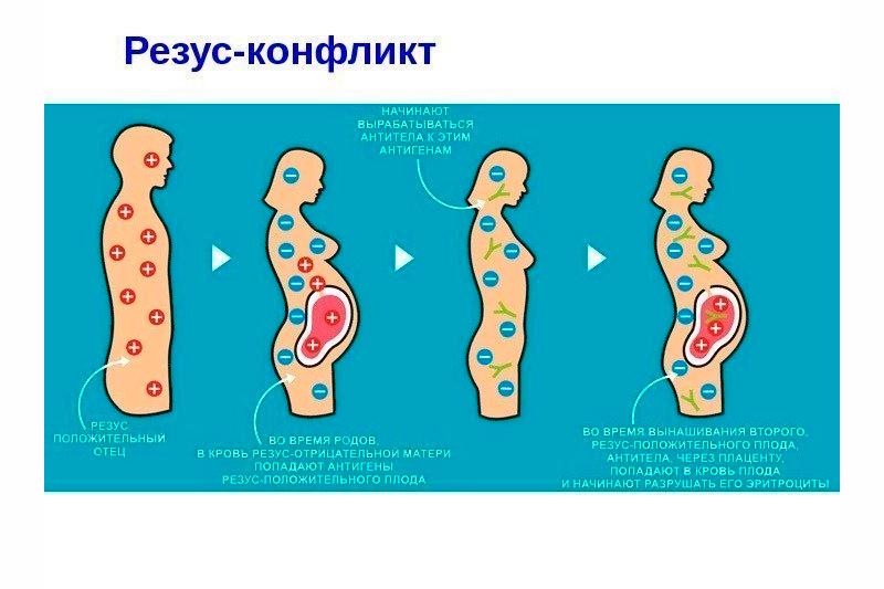 Симптомы резус-конфликта при беременности