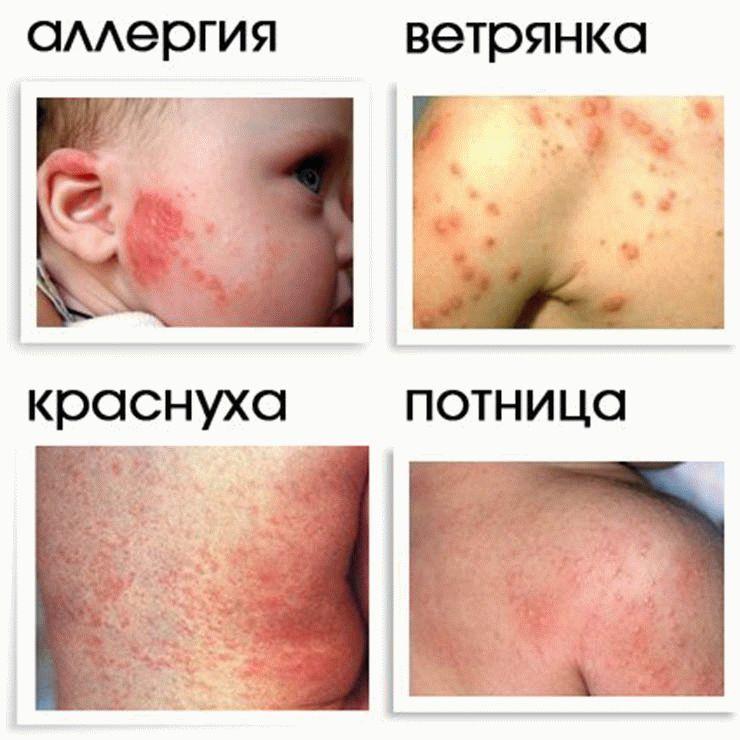 Высыпания на теле грудничка