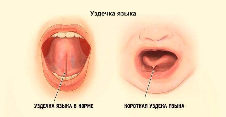 Короткая уздечка у ребенка