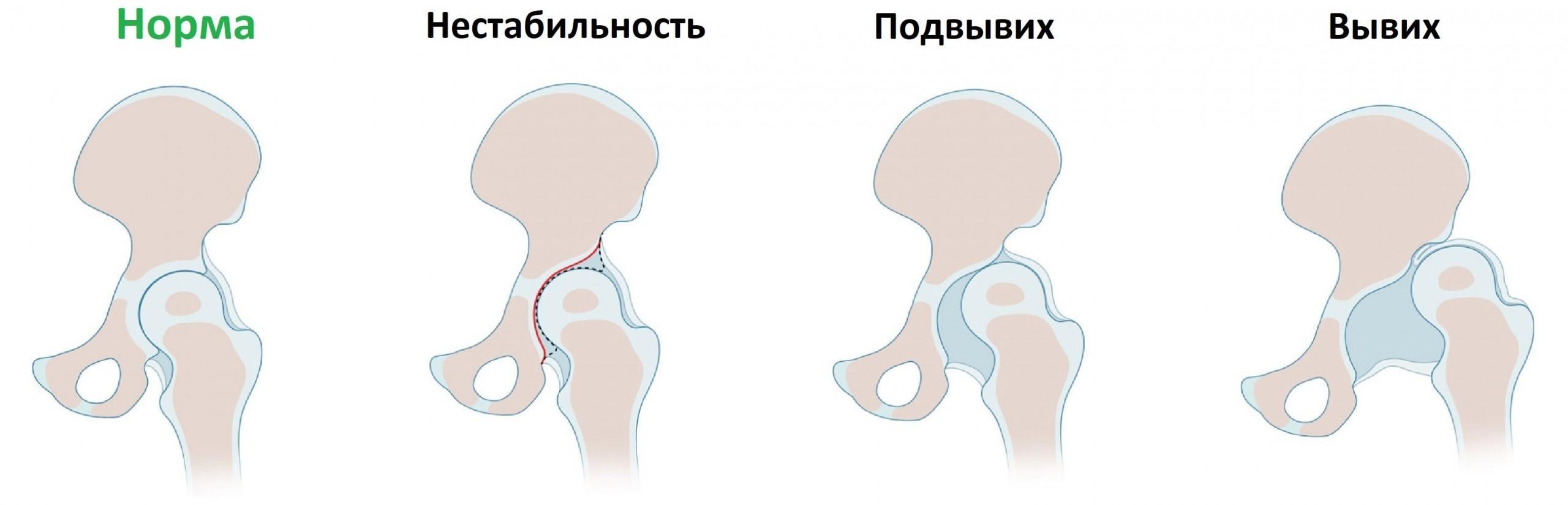 Виды ДТБС