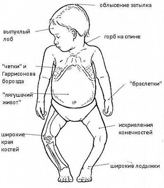 Рахит у малыша