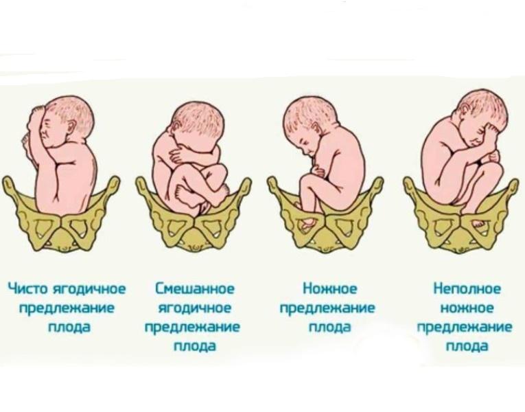 Тазовое предлежание