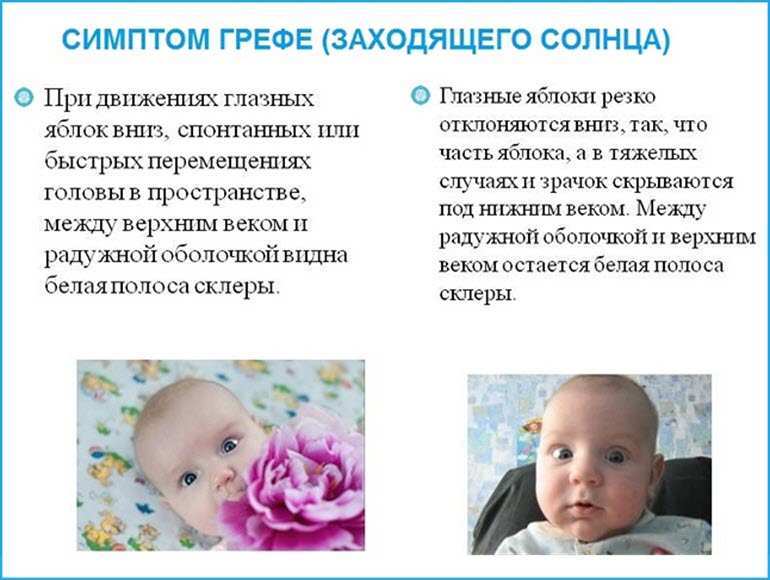Признак ВЧД у ребенка – синдром Грефе