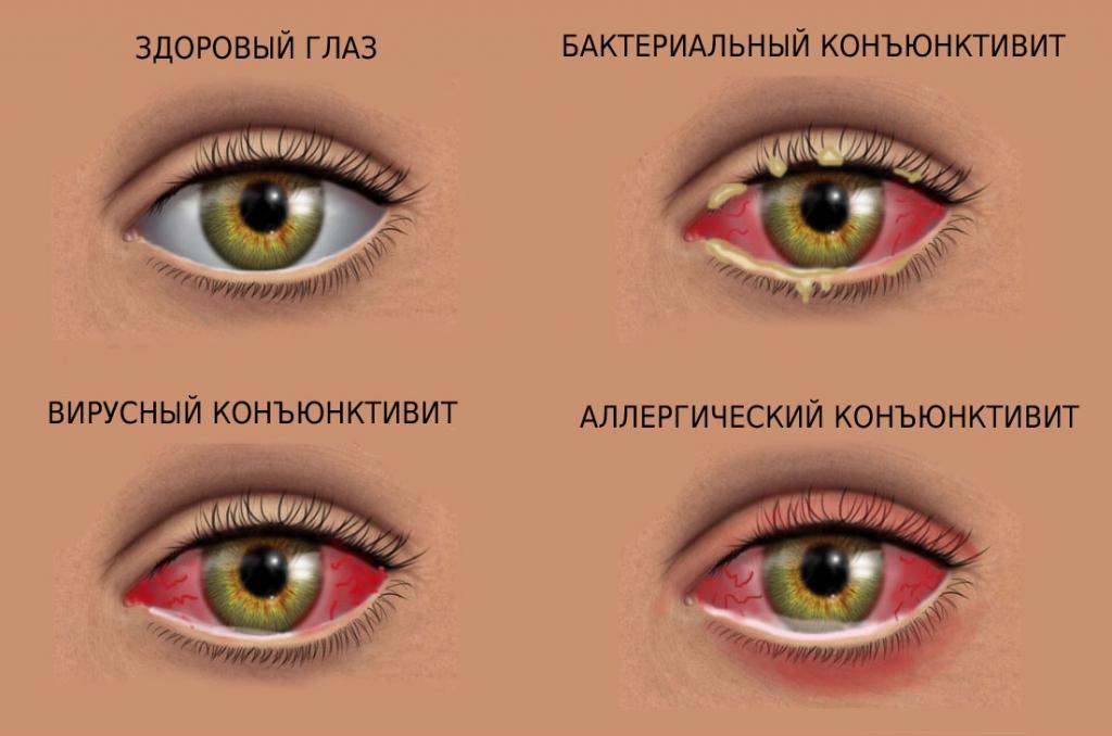 Признаки конъюнктивита