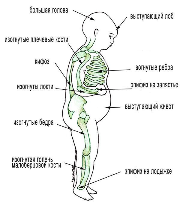 Признаки рахита у младенца