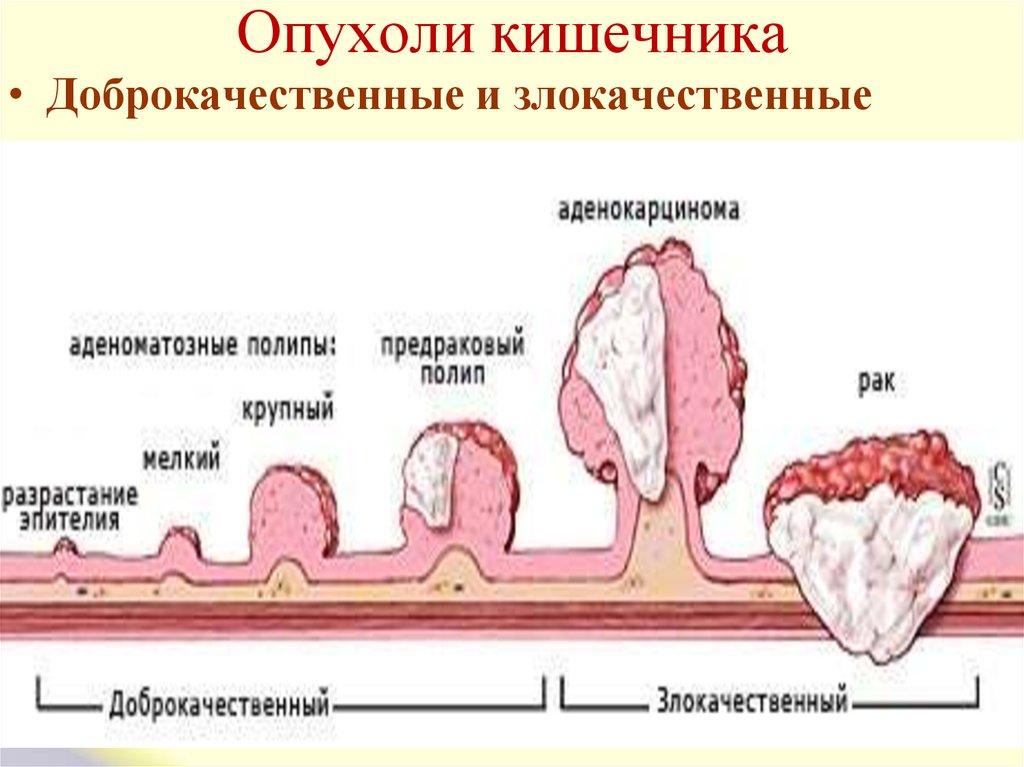 Новообразования в кишечнике