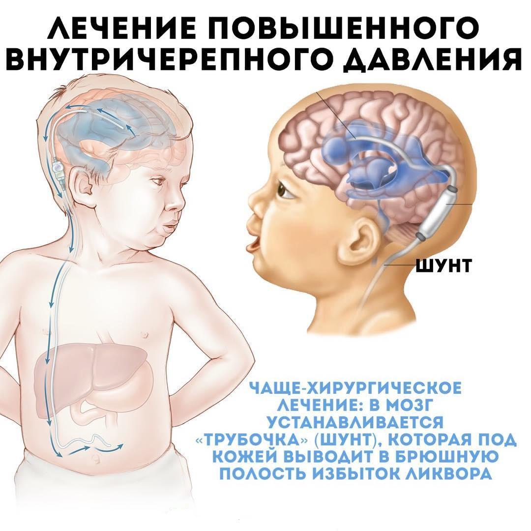 Лечение ВЧД