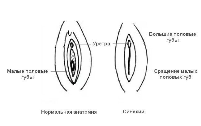 Схематическое изображение разницы между нормой и синехиями