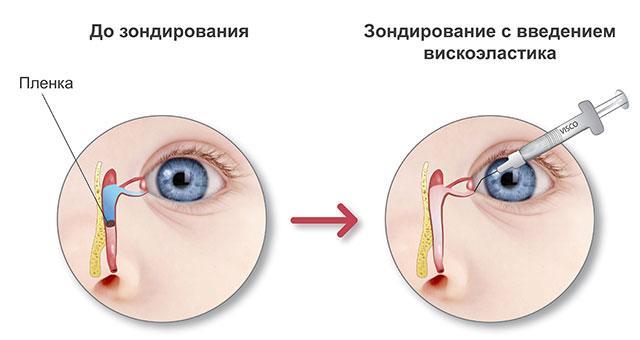 Зондирование слезного канальца