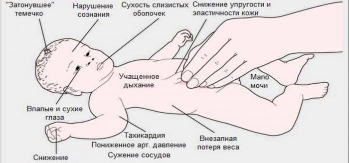 Признаки обезвоживания
