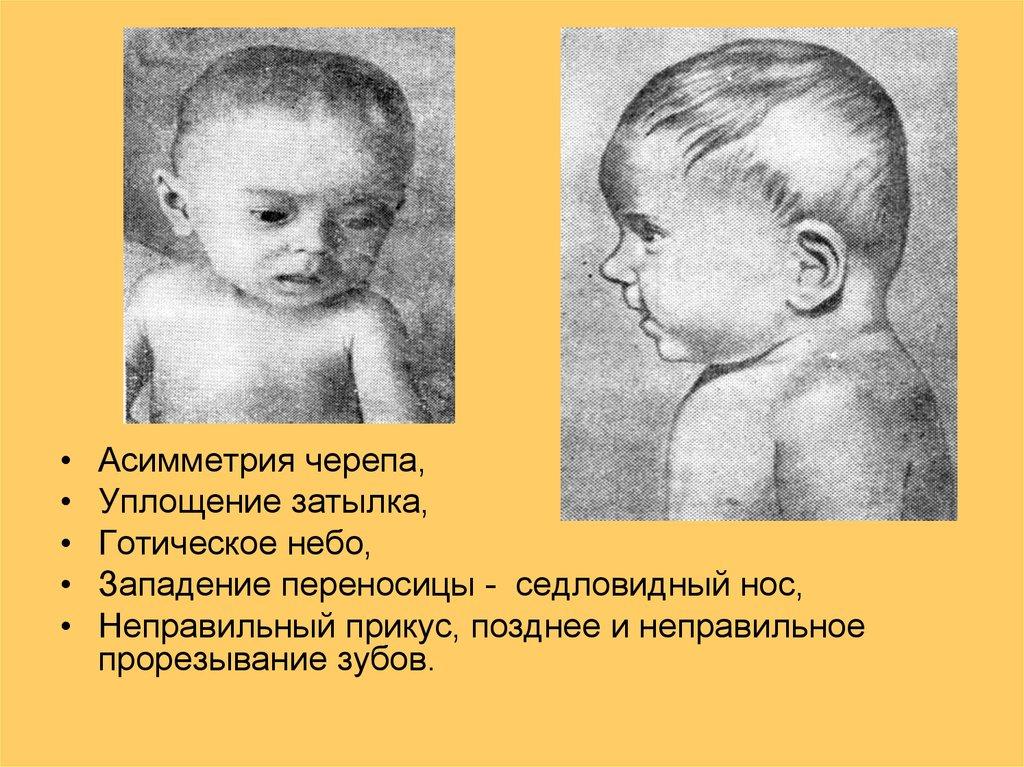 Внешние симптомы рахита