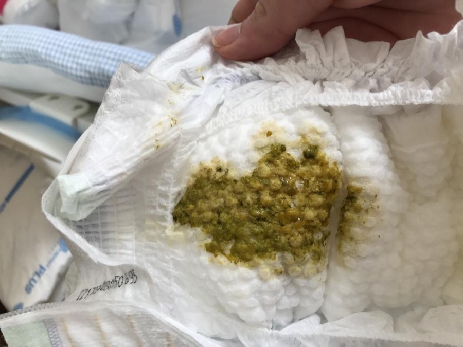 Зеленый цвет кала не всегда является признаком патологии