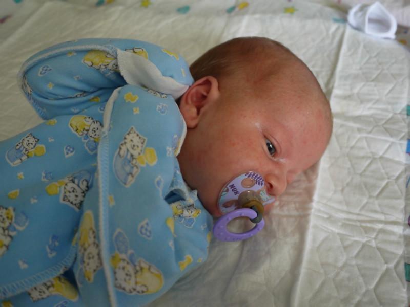 Грудничок с аллергическими высыпаниями на лице