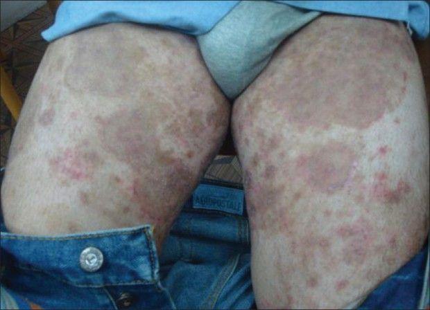 Запущенный случай пахового грибка